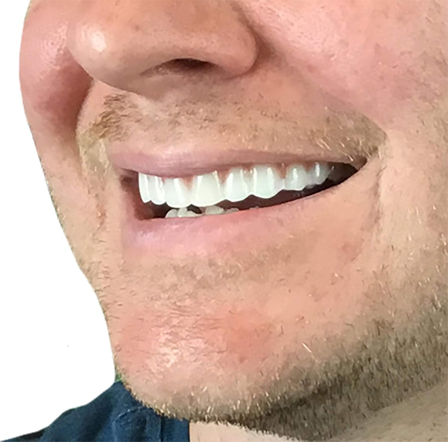 Instant Smile Comfort Fit Flex - Bright Shade - Upper Veneer Cosmetic Teeth
