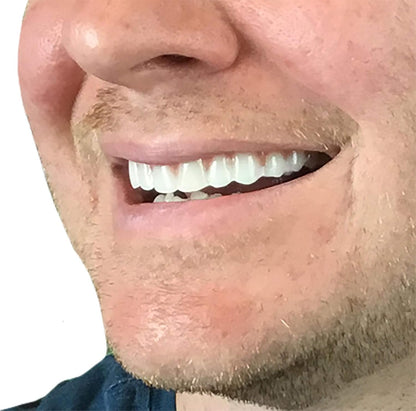 Instant Smile Comfort Fit Flex - Bright Shade - Upper Veneer Cosmetic Teeth