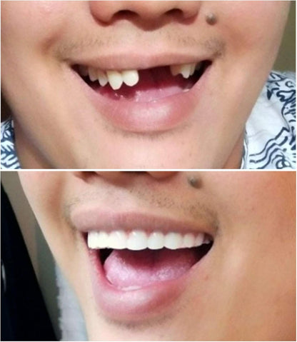 Instant Smile Comfort Fit Flex - Bright Shade - Upper Veneer Cosmetic Teeth